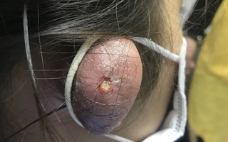 Cẩn trọng biến chứng nguy hiểm khi xỏ khuyên trên vành tai