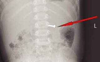 Trẻ 19 tháng tuổi nuốt ốc vít 1,5cm