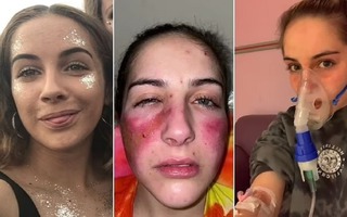 Cô gái siêu dị ứng, chỉ cần cười nhiều hay nổi cáu là làn da như bị tạt axit