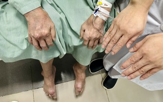 Cảnh báo tình trạng gout nặng do lạm dụng bia, rượu
