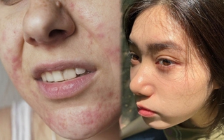 1 kiểu dùng mỹ phẩm khiến làn da bị tổn thương khó hồi phục, thời điểm cận Tết hội chị em nhất định phải tránh
