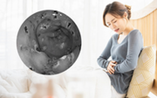 Dạ dày người phụ nữ "thủng" đến 30 vết chỉ do một sơ suất, có vấn đề đường tiêu hoá đặc biệt lưu ý