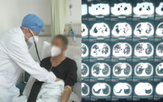 Người đàn ông hai nửa phổi gần như "biến mất", vĩnh viễn không thể phục hồi do một thói quen kinh hoàng suốt 20 năm