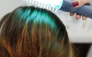 Cấy tóc, mọc tóc, giảm mỡ bụng - máy lazer làm được hết: Chuyên gia nói gì?
