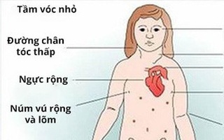 Thấy con thấp hơn bạn cùng trang lứa, đưa đi khám phát hiện mắc hội chứng Turner