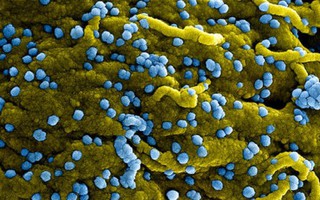 Bệnh do virus Marburg khó chẩn đoán