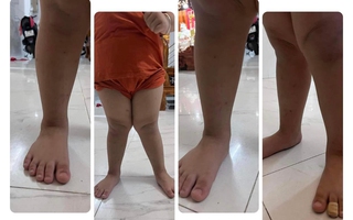 Bàn chân bẹt: Chuyên gia tiết lộ thời điểm vàng mẹ cần cho con đi khám