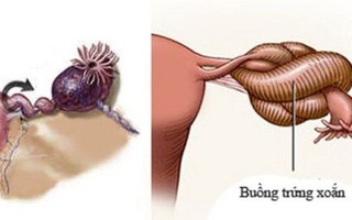 Bé gái hơn 1 tuổi ở Nghệ An phải cắt bỏ buồng trứng