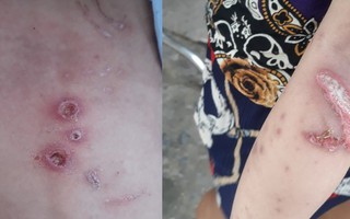 Vụ bé trai nghi bị cha mẹ đánh đập dã man: Cháu bé bị gãy biến dạng cánh tay, bỏng độ 1-2