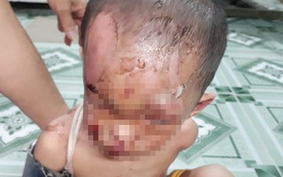 Nghi vấn bé trai ở TP.HCM bị cha mẹ đánh đập dã man, trên người đầy vết thương