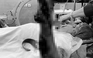 Phẫu thuật khẩn trong đêm cứu bàn tay bị máy cưa nghiền nát