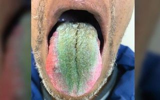 Kỳ lạ người đàn ông có lông mọc dày và xanh lè trên lưỡi