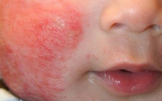 Trẻ bị viêm da cơ địa nên mặc quần áo ra sao để tránh kích ứng?