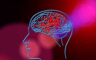 Tìm ra phương pháp mới có thể giảm nguy cơ tái phát đột quỵ