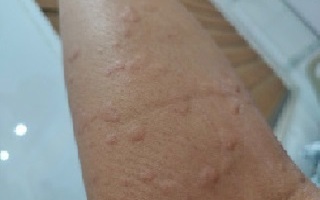 Sốc phản vệ độ 3 vì bị kiến đốt