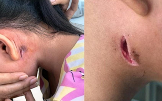 Nhiều người nhiễm vi khuẩn "ăn thịt người", Bộ Y tế ra khuyến cáo