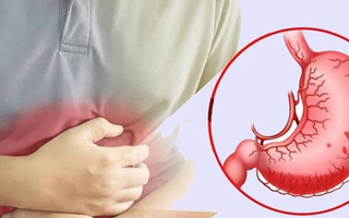 Bé trai thủng dạ dày do vi khuẩn HP, bác sĩ khuyến cáo những việc cần thay đổi trong gia đình để phòng bệnh