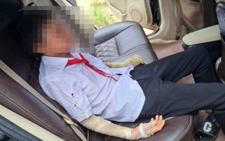 Nổ bóng bay ngày khai giảng, 7 học sinh bị bỏng