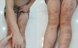 Vụ 6 trẻ mầm non bị đánh bầm tím người ở Nghệ An: Thông tin mới nhất