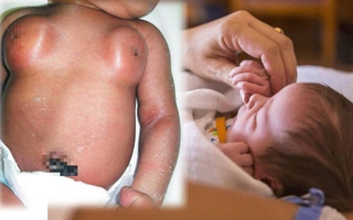 Bé sơ sinh 8 ngày tuổi có ngực to như cái chén, gia đình sợ hãi cầu cứu bác sĩ mà không biết sự thật