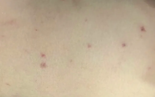 Trẻ mắc não mô cầu nặng do chưa tiêm vaccine phòng bệnh