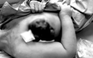 Đắp thuốc nam điều trị ung thư vú, người bệnh bị vỡ, loét hoại tử vú