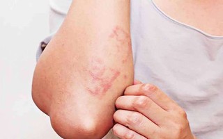 Tự nhiên ngứa điên và nổi mẩn ở da, hãy nghĩ đến việc tẩy giun