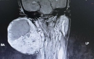 Suýt mất mạng vì mang khối u khổng lồ 14 năm không điều trị