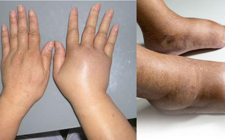 Chân tay phù nề, kiểm tra ngay sức khỏe của quả thận