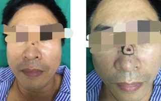 Người đàn ông Hà Nội phát hiện sự thật bàng hoàng đằng sau nốt ruồi 'phong thủy'