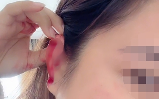 Hà Nội: Cô gái cầu cứu sau khi bị bạn cùng phòng trọ hành hung rách tai vì lấy nhầm nồi nấu ăn