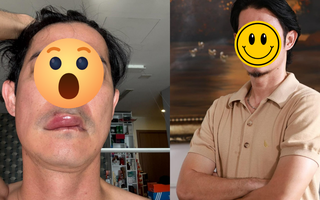 Sao nam Vbiz phát hoảng vì mặt biến dạng, sưng phồng bất thường