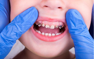 Chỉ vì một hiểu lầm về răng sữa, mẹ vô tình khiến con dễ bị sâu sún răng mà không hay