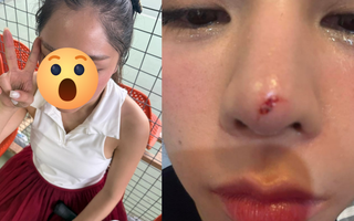 Thêm sao nữ Vbiz gặp tai nạn trên sân pickleball, vết thương chảy máu giữa mặt