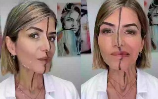 Nữ bác sĩ tiêm botox nửa khuôn mặt để chứng minh tác hại của cách làm đẹp này