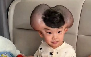 Nốt ruồi khổng lồ phủ kín hộp sọ khiến cậu bé có ngoại hình giống chuột Mickey