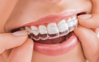 Những lưu ý đặc biệt khi niềng răng để khỏi 'tiền mất tật mang'