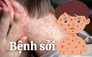 Bệnh sởi gia tăng: Nguy hiểm không phải chỉ với trẻ em