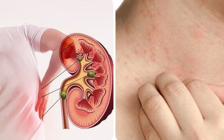 5 dấu hiệu suy thận giai đoạn đầu bạn cần biết