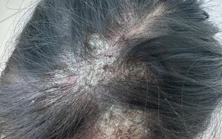 Bệnh Kerion de Celse ở trẻ em: Nguy cơ rụng tóc vĩnh viễn nếu chủ quan