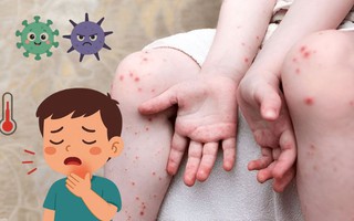 Infographic: Cảnh giác với bệnh Tay Chân Miệng ở trẻ em