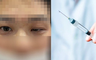 Bi hài hậu vận sau thẩm mỹ: Tiêm botox để thành "hot girl", cô gái nhận cái kết "mặt đơ như tượng"