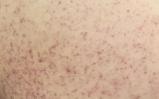 Cô gái 21 tuổi suýt mất mạng vì sốc sốt xuất huyết Dengue nặng