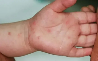 TP Hồ Chí Minh: Bệnh tay chân miệng tăng 49%, cảnh báo nguy cơ bùng dịch