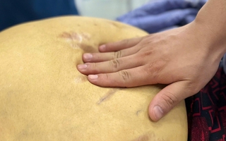 'Nát' gan, đối mặt ung thư vì thói quen nhiều người Việt vô tư làm