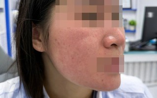 Bỏng da mặt vì dùng chanh tươi trị mụn