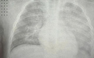 Bé 8 tháng tuổi phổi trắng xóa do biến chứng sởi