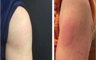 Tiêm vắc xin HPV có phản ứng phụ nào không, khi nào cần gặp bác sĩ?