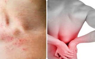 Những triệu chứng suy thận nhẹ bạn cần biết