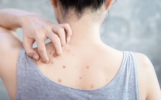 Mọc mụn ở lưng có phải do nóng gan?